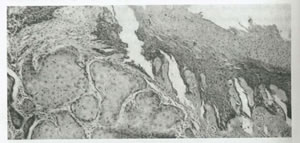 انواع بیماریهای فرج و مهبل